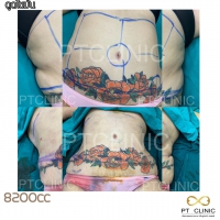 S__131891290.jpg - ดูดไขมัน แผลเล็กมาก เจ็บน้อย ชิวชิว ไม่ต้องวางยา | https://ptinfinity.com