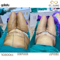 S__131891291.jpg - ดูดไขมัน แผลเล็กมาก เจ็บน้อย ชิวชิว ไม่ต้องวางยา | https://ptinfinity.com