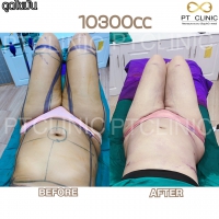 S__131891292.jpg - ดูดไขมัน แผลเล็กมาก เจ็บน้อย ชิวชิว ไม่ต้องวางยา | https://ptinfinity.com