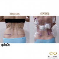 S__131891293.jpg - ดูดไขมัน แผลเล็กมาก เจ็บน้อย ชิวชิว ไม่ต้องวางยา | https://ptinfinity.com