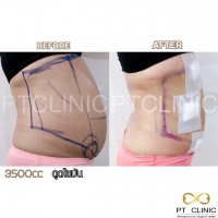 S__131891294.jpg - ดูดไขมัน แผลเล็กมาก เจ็บน้อย ชิวชิว ไม่ต้องวางยา | https://ptinfinity.com