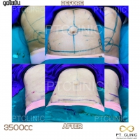 S__131891296.jpg - ดูดไขมัน แผลเล็กมาก เจ็บน้อย ชิวชิว ไม่ต้องวางยา | https://ptinfinity.com