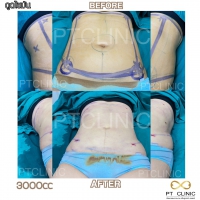 S__131891297.jpg - ดูดไขมัน แผลเล็กมาก เจ็บน้อย ชิวชิว ไม่ต้องวางยา | https://ptinfinity.com