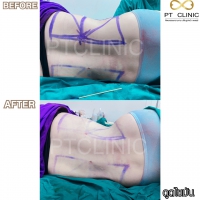 S__131891298.jpg - ดูดไขมัน แผลเล็กมาก เจ็บน้อย ชิวชิว ไม่ต้องวางยา | https://ptinfinity.com