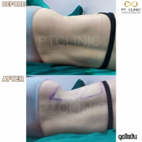 S__131891299.jpg - ดูดไขมัน แผลเล็กมาก เจ็บน้อย ชิวชิว ไม่ต้องวางยา | https://ptinfinity.com