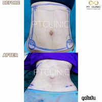 S__131891300.jpg - ดูดไขมัน แผลเล็กมาก เจ็บน้อย ชิวชิว ไม่ต้องวางยา | https://ptinfinity.com