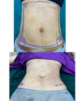 S__131891301.jpg - ดูดไขมัน แผลเล็กมาก เจ็บน้อย ชิวชิว ไม่ต้องวางยา | https://ptinfinity.com