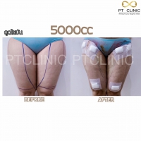 S__131891302.jpg - ดูดไขมัน แผลเล็กมาก เจ็บน้อย ชิวชิว ไม่ต้องวางยา | https://ptinfinity.com