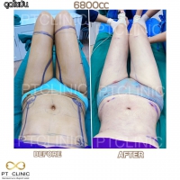 S__131891303.jpg - ดูดไขมัน แผลเล็กมาก เจ็บน้อย ชิวชิว ไม่ต้องวางยา | https://ptinfinity.com