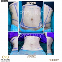 S__131891304.jpg - ดูดไขมัน แผลเล็กมาก เจ็บน้อย ชิวชิว ไม่ต้องวางยา | https://ptinfinity.com