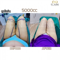 S__131891305.jpg - ดูดไขมัน แผลเล็กมาก เจ็บน้อย ชิวชิว ไม่ต้องวางยา | https://ptinfinity.com