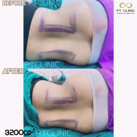 S__131891308.jpg - ดูดไขมัน แผลเล็กมาก เจ็บน้อย ชิวชิว ไม่ต้องวางยา | https://ptinfinity.com