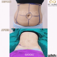 S__131891309.jpg - ดูดไขมัน แผลเล็กมาก เจ็บน้อย ชิวชิว ไม่ต้องวางยา | https://ptinfinity.com