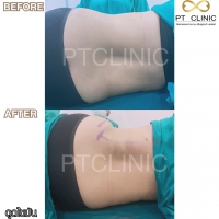 S__131891310.jpg - ดูดไขมัน แผลเล็กมาก เจ็บน้อย ชิวชิว ไม่ต้องวางยา | https://ptinfinity.com