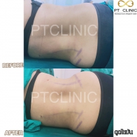 S__131891311.jpg - ดูดไขมัน แผลเล็กมาก เจ็บน้อย ชิวชิว ไม่ต้องวางยา | https://ptinfinity.com