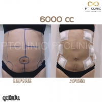 S__131891312.jpg - ดูดไขมัน แผลเล็กมาก เจ็บน้อย ชิวชิว ไม่ต้องวางยา | https://ptinfinity.com