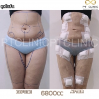 S__131891314.jpg - ดูดไขมัน แผลเล็กมาก เจ็บน้อย ชิวชิว ไม่ต้องวางยา | https://ptinfinity.com