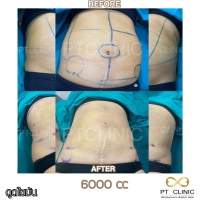 S__131891315.jpg - ดูดไขมัน แผลเล็กมาก เจ็บน้อย ชิวชิว ไม่ต้องวางยา | https://ptinfinity.com