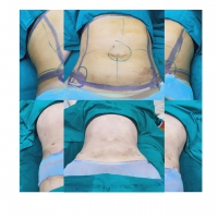 S__131891316.jpg - ดูดไขมัน แผลเล็กมาก เจ็บน้อย ชิวชิว ไม่ต้องวางยา | https://ptinfinity.com