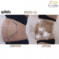 S__131891318.jpg - ดูดไขมัน แผลเล็กมาก เจ็บน้อย ชิวชิว ไม่ต้องวางยา | https://ptinfinity.com