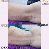 S__131891319.jpg - ดูดไขมัน แผลเล็กมาก เจ็บน้อย ชิวชิว ไม่ต้องวางยา | https://ptinfinity.com