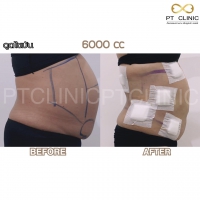 S__131891321.jpg - ดูดไขมัน แผลเล็กมาก เจ็บน้อย ชิวชิว ไม่ต้องวางยา | https://ptinfinity.com