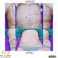 S__131891322.jpg - ดูดไขมัน แผลเล็กมาก เจ็บน้อย ชิวชิว ไม่ต้องวางยา | https://ptinfinity.com