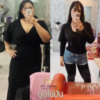 S__131891323.jpg - ดูดไขมัน แผลเล็กมาก เจ็บน้อย ชิวชิว ไม่ต้องวางยา | https://ptinfinity.com