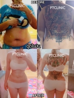 S__131891348.jpg - ดูดไขมัน แผลเล็กมาก เจ็บน้อย ชิวชิว ไม่ต้องวางยา | https://ptinfinity.com