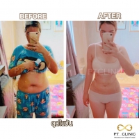 S__131891350.jpg - ดูดไขมัน แผลเล็กมาก เจ็บน้อย ชิวชิว ไม่ต้องวางยา | https://ptinfinity.com