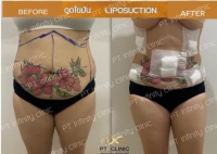 a3.jpg - ดูดไขมัน แผลเล็กมาก เจ็บน้อย ชิวชิว ไม่ต้องวางยา | https://ptinfinity.com