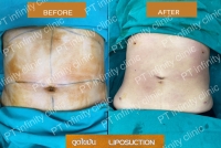 a4.jpg - ดูดไขมัน แผลเล็กมาก เจ็บน้อย ชิวชิว ไม่ต้องวางยา | https://ptinfinity.com