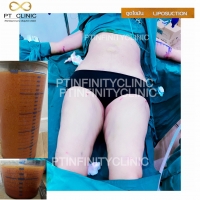 a7.jpg - ดูดไขมัน แผลเล็กมาก เจ็บน้อย ชิวชิว ไม่ต้องวางยา | https://ptinfinity.com