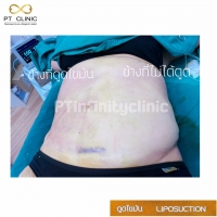 a8.jpg - ดูดไขมัน แผลเล็กมาก เจ็บน้อย ชิวชิว ไม่ต้องวางยา | https://ptinfinity.com