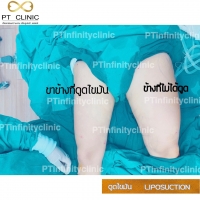 b1.jpg - ดูดไขมัน แผลเล็กมาก เจ็บน้อย ชิวชิว ไม่ต้องวางยา | https://ptinfinity.com