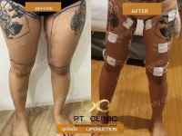 b3.jpg - ดูดไขมัน แผลเล็กมาก เจ็บน้อย ชิวชิว ไม่ต้องวางยา | https://ptinfinity.com