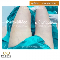 b8.jpg - ดูดไขมัน แผลเล็กมาก เจ็บน้อย ชิวชิว ไม่ต้องวางยา | https://ptinfinity.com