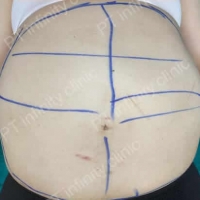 c2.jpg - ดูดไขมัน แผลเล็กมาก เจ็บน้อย ชิวชิว ไม่ต้องวางยา | https://ptinfinity.com