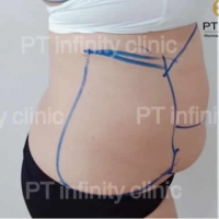 c3.jpg - ดูดไขมัน แผลเล็กมาก เจ็บน้อย ชิวชิว ไม่ต้องวางยา | https://ptinfinity.com