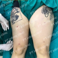 c8.jpg - ดูดไขมัน แผลเล็กมาก เจ็บน้อย ชิวชิว ไม่ต้องวางยา | https://ptinfinity.com