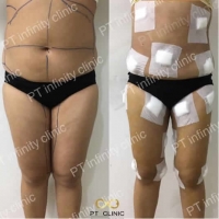 c9.jpg - ดูดไขมัน แผลเล็กมาก เจ็บน้อย ชิวชิว ไม่ต้องวางยา | https://ptinfinity.com