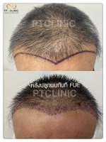 S__146047011.jpg - ปลูกผม | https://ptinfinity.com