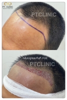 S__146047015.jpg - ปลูกผม | https://ptinfinity.com