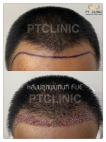 S__146047018.jpg - ปลูกผม | https://ptinfinity.com