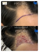 S__146047019.jpg - ปลูกผม | https://ptinfinity.com