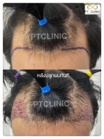 S__146047020.jpg - ปลูกผม | https://ptinfinity.com