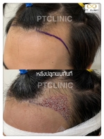 S__146047021.jpg - ปลูกผม | https://ptinfinity.com