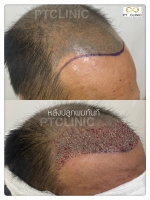 S__146047023.jpg - ปลูกผม | https://ptinfinity.com