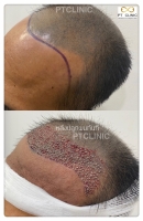 S__146047026.jpg - ปลูกผม | https://ptinfinity.com