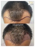 S__146047028.jpg - ปลูกผม | https://ptinfinity.com